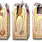 Endodontics (Root Canal) at Bioral Dental Group