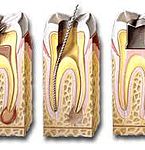 Endodontics (Root Canal) at Bioral Dental Group