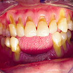 Periodontics at Bioral Dental Group